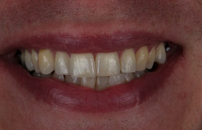 Before (Teeth)