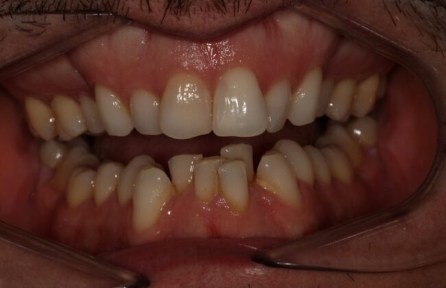 Before (Teeth)