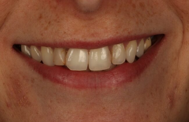 Before (Teeth)