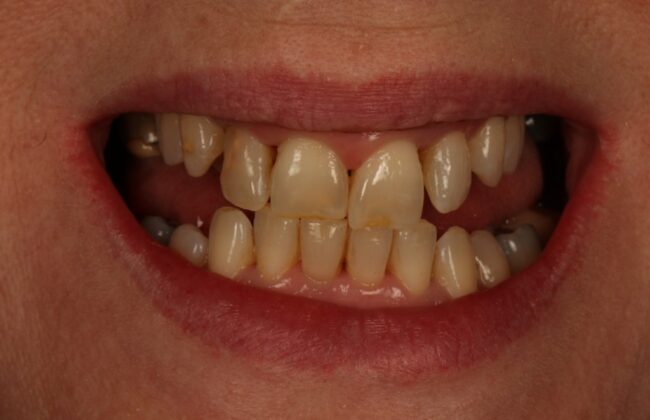 Before (Teeth)