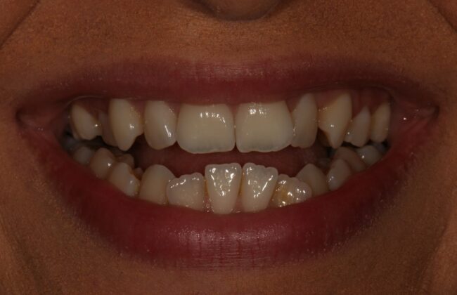 Before (Teeth)
