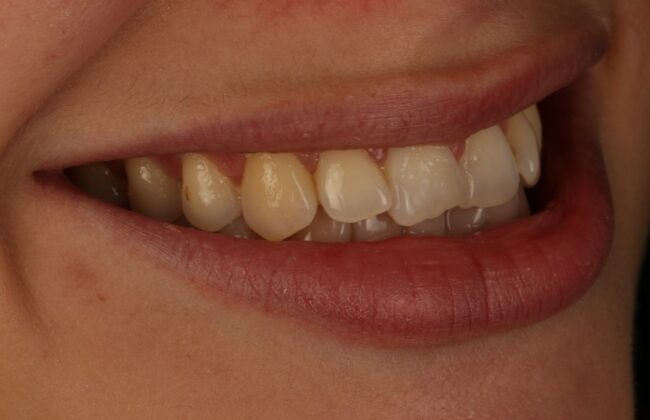 Before (Teeth)