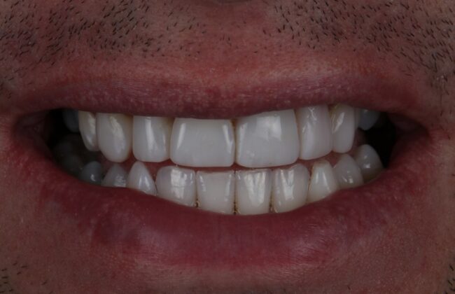 After (Teeth)