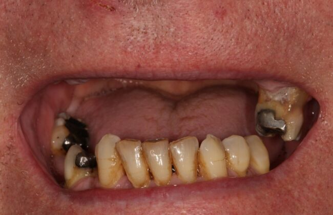 Before (Teeth)