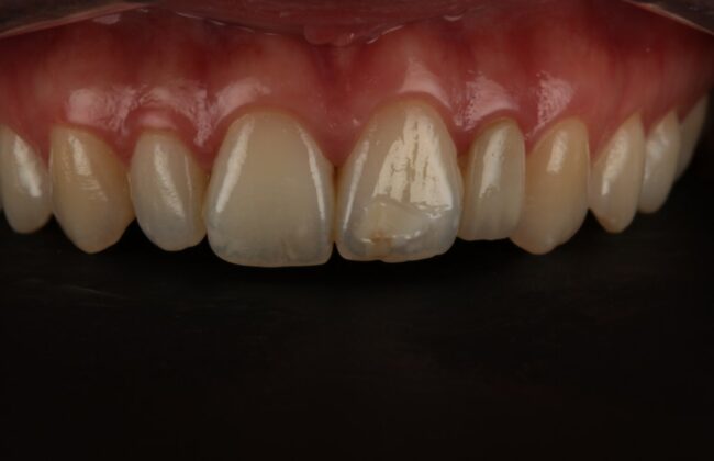 Before (Teeth)