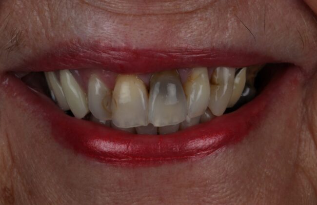 Before (Teeth)