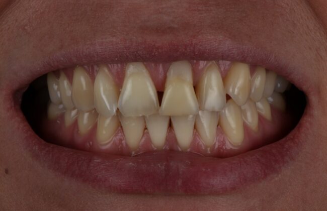 Before (Teeth)