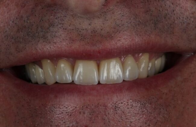 After (Teeth)