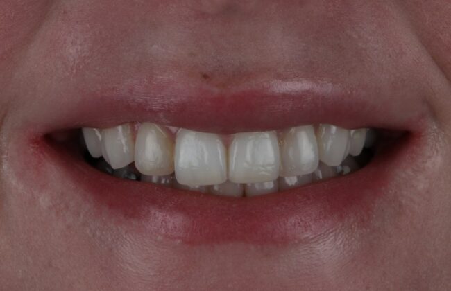 Before (Teeth)