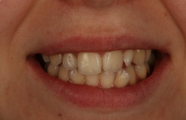Before (Teeth)