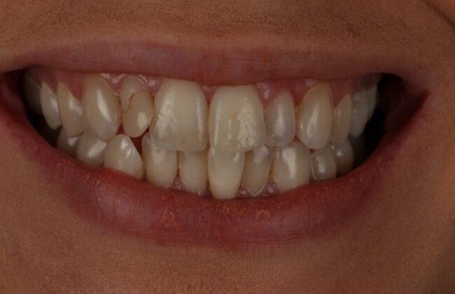 Before (Teeth)