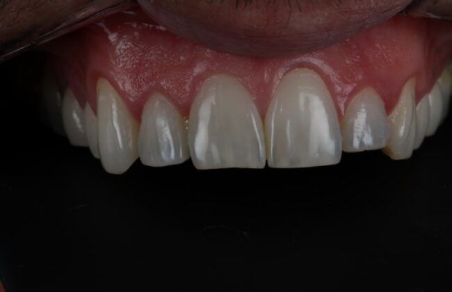 Before (Teeth)