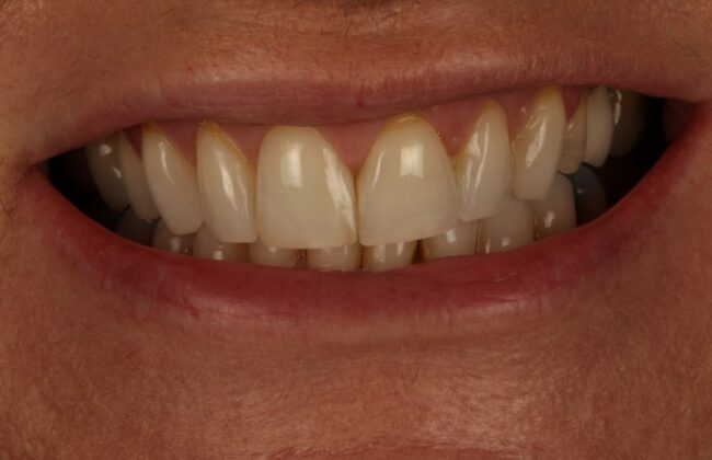 Before (Teeth)