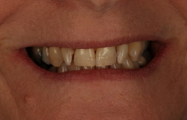 Before (Teeth)