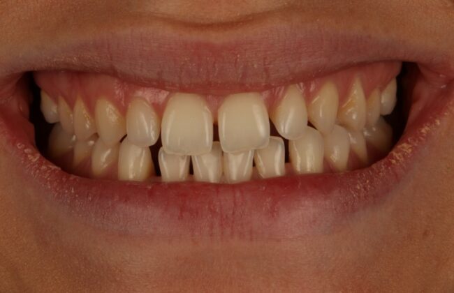 Before (Teeth)