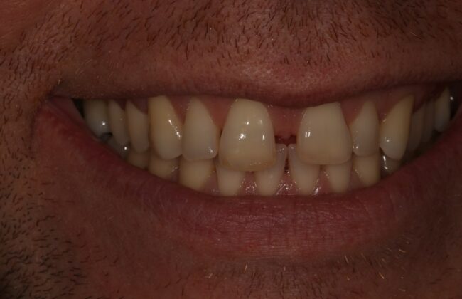 Before (Teeth)