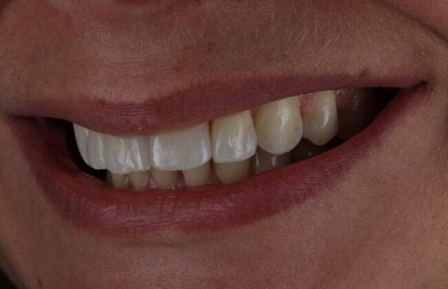 After (Teeth)