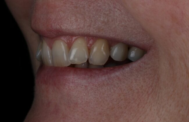 After (Teeth)