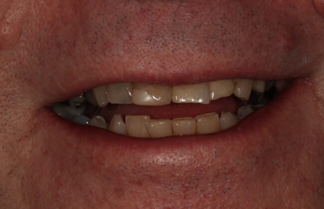After (Teeth)