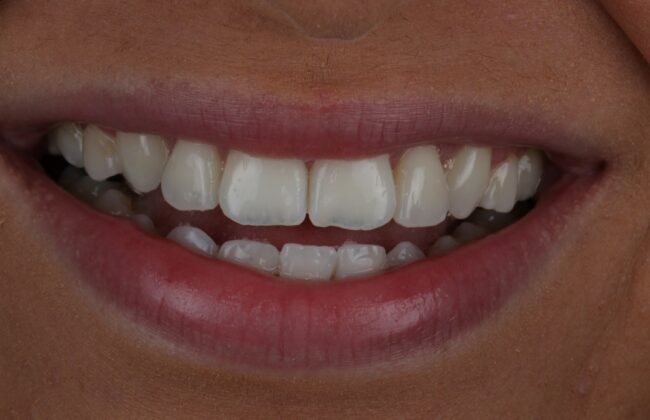 After (Teeth)