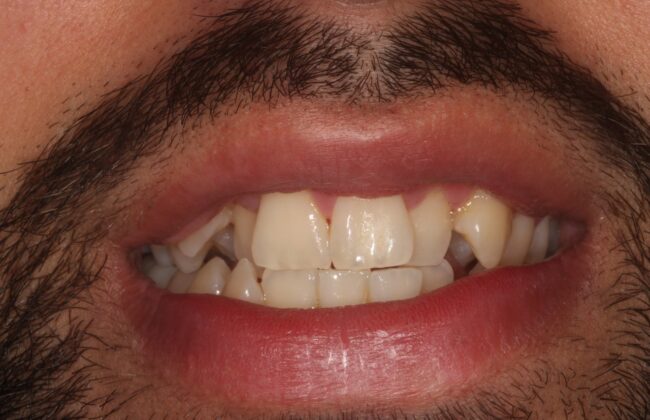Before (Teeth)