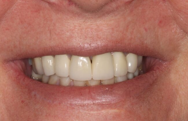 After (Teeth)
