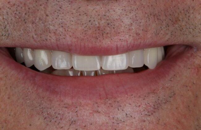 After (Teeth)