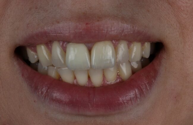 After (Teeth)