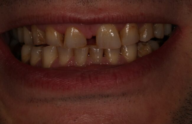 Before (Teeth)