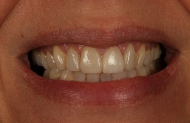 After (Teeth)