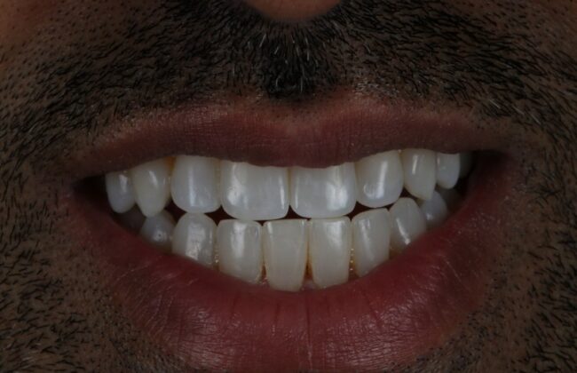 After (Teeth)