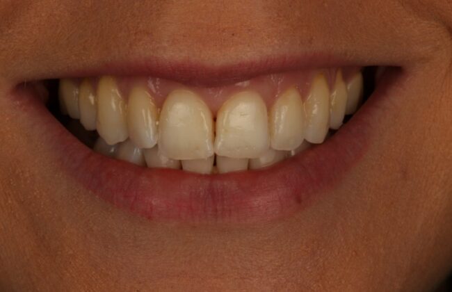 After (Teeth)