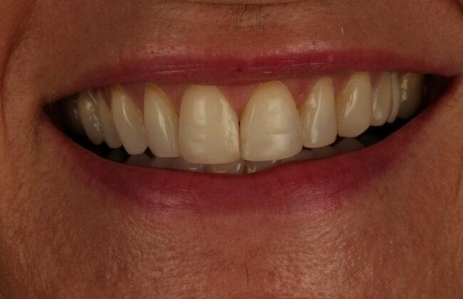 After (Teeth)