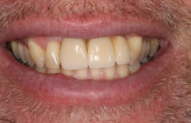 After (Teeth)