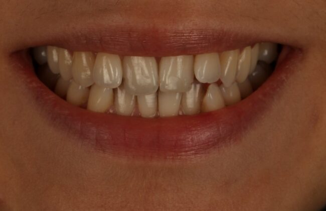 Before (Teeth)