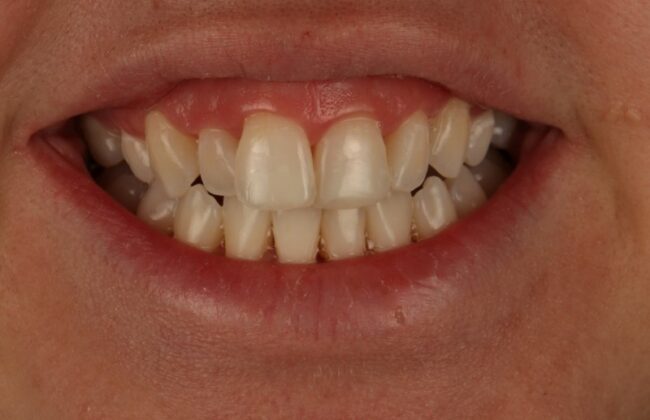 After (Teeth)