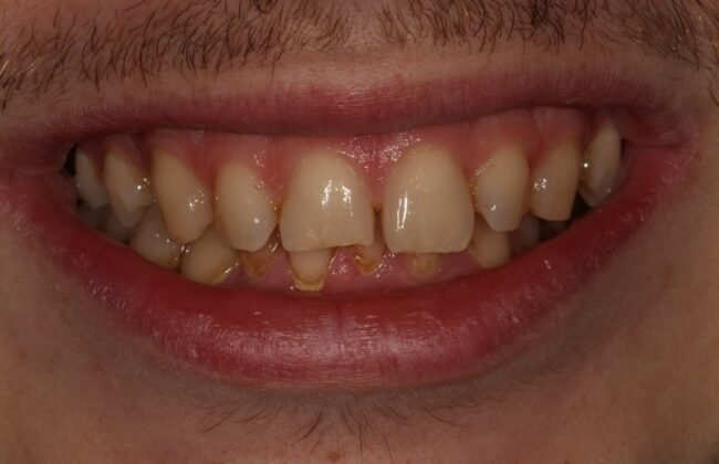 Before (Teeth)