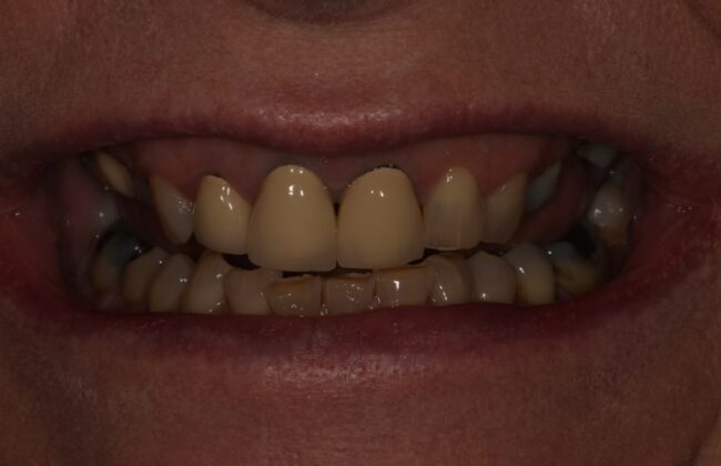 Before (Teeth)