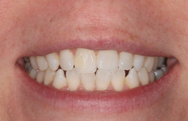 Before (Teeth)