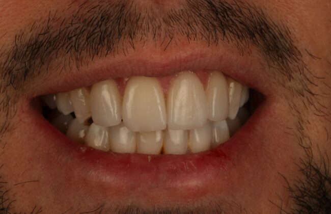 After (Teeth)