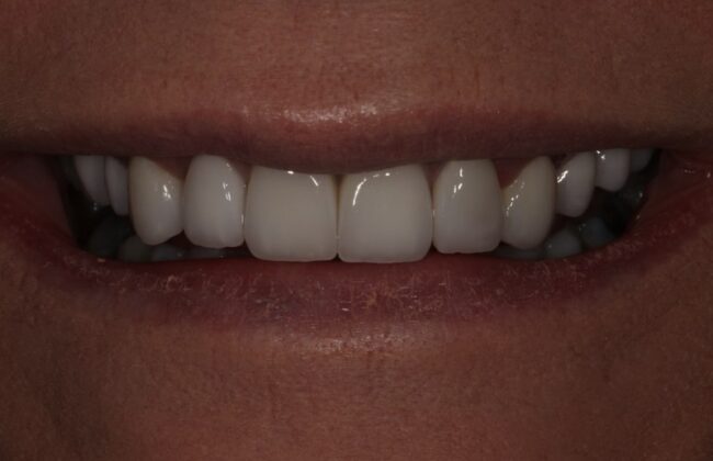 After (Teeth)