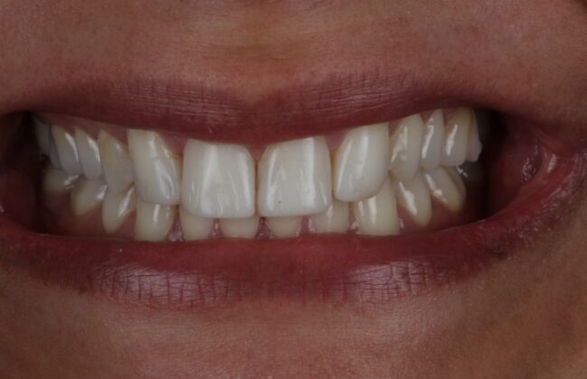 After (Teeth)