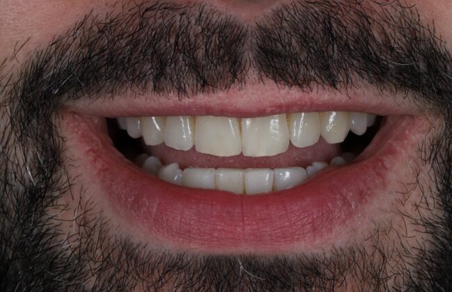 After (Teeth)