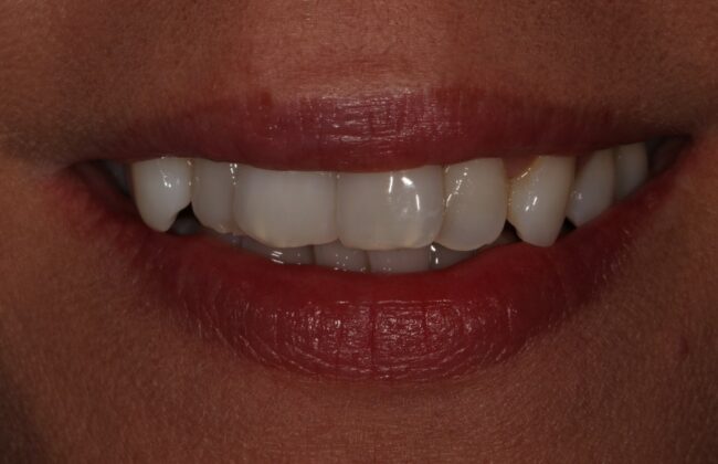 Before (Teeth)
