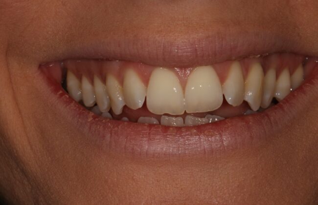 Before (Teeth)