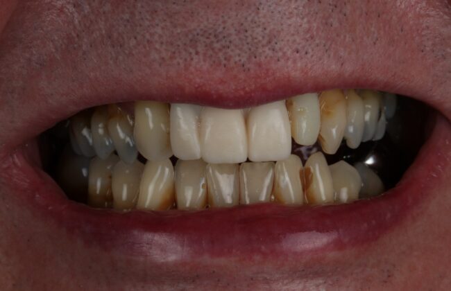 Before (Teeth)