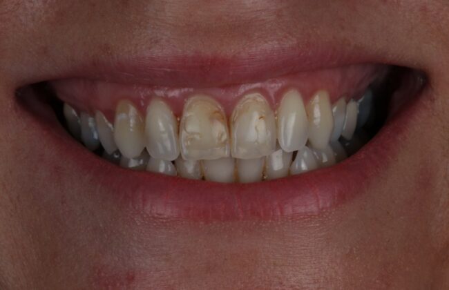 Before (Teeth)