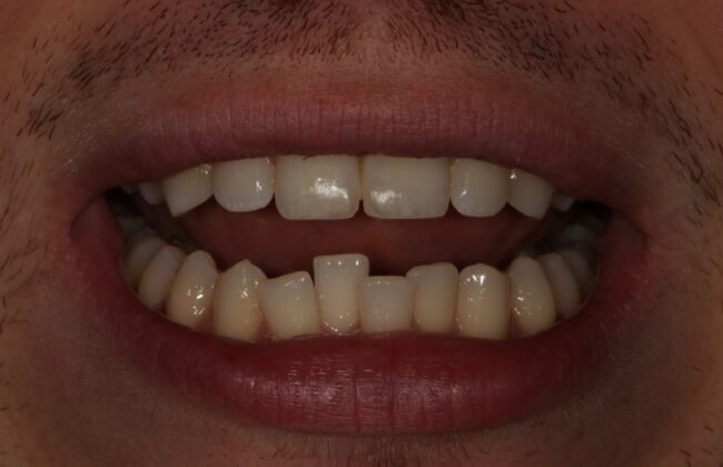 Before (Teeth)