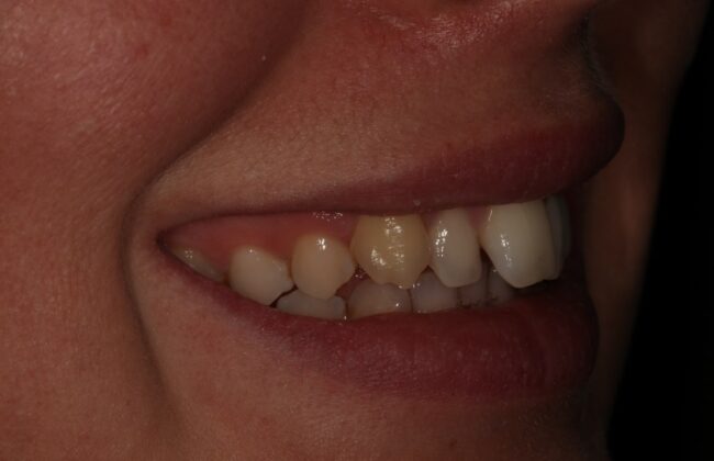 Before (Teeth)