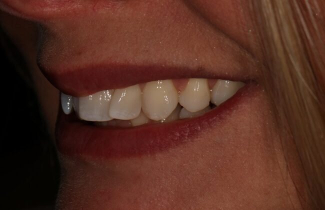 Before (Teeth)